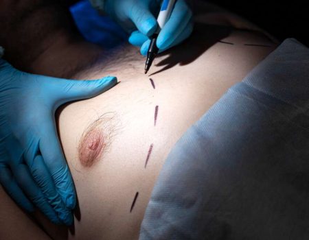 A Look At Best Gynecomastia Surgeon